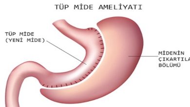 Tüp Mide Ameliyatı Nedir ve Neden Yapılır
